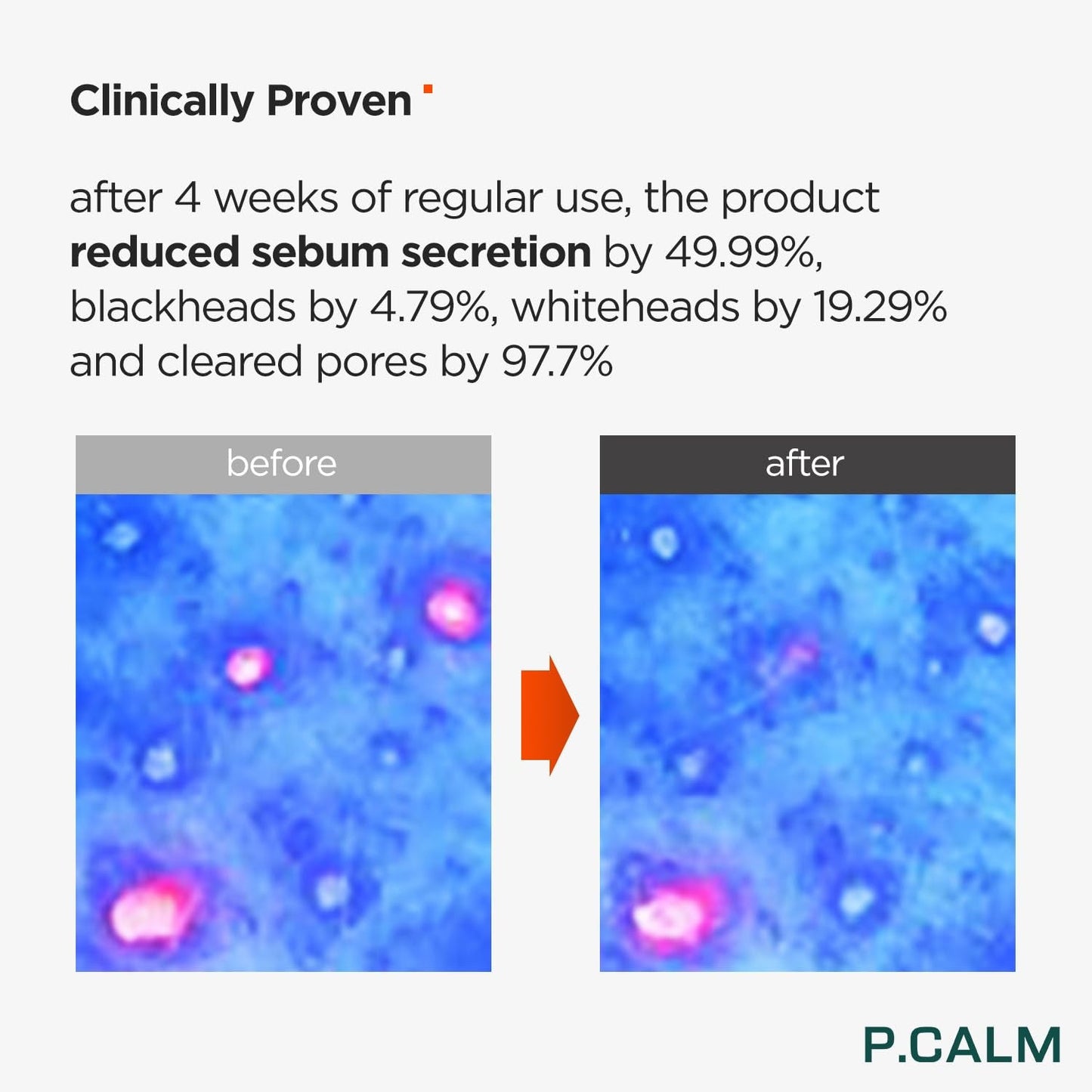 P.Calm Underpore Foam Cleanser